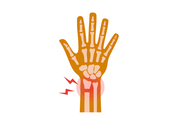 An illustration of a hand and wrist. The bones of the hand, wrist, and forearm are visible, and the bone on the left of the forearm is broken at the wrist. A semi-transparent red circle and two red lightning bolts emanate from the break.