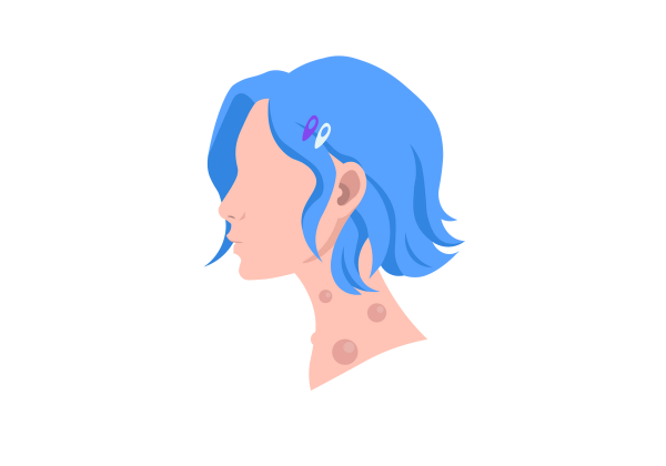 An illustration of the side profile of a woman with lumps on her neck. She has short blue hair pulled back with purple and light green hair clips.