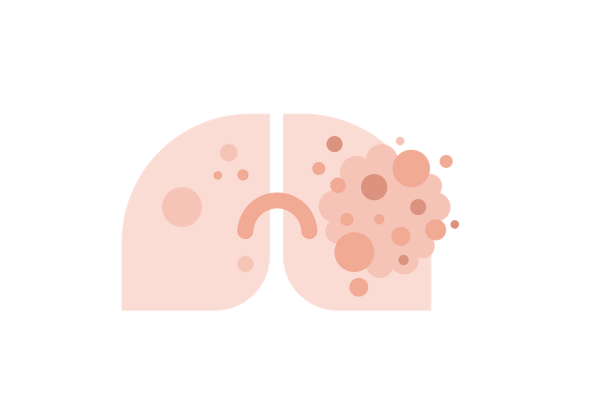 Lung with cancer growth