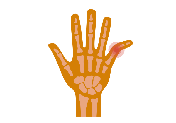 An illustration of a hand with outstretched fingers. The hand is medium caramel-toned and the bones are visible in a lighter shade through the skin. The pinky, on the right, is bent outward at an angle at the second knuckle. Red circles come from the joint, emphasizing the area.