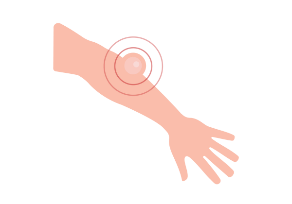 A forearm diagonal from the top left to the bottom right. A lump is towards the elbow with red concentric circles emanating from it.