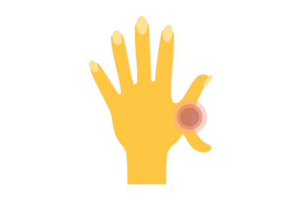 An illustration of a hand deformed by Fanconi anemia. The hand is yellow, and there is an extra thumb protruding from the hand. Red concentric circles emanate from where the thumb meets the hand.