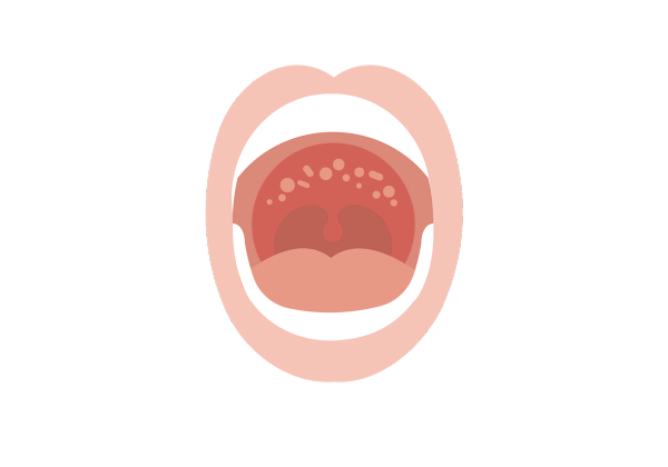 Open mouth with sores on the roof of the mouth.