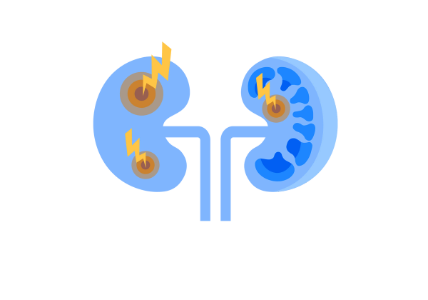 Two blue kidneys. The left one has two sets of yellow concentric circles with yellow lightning bolts emanating from each. The right has darker blue mushroom-shaped holes and another set of concentric circles with a lightning bolt.