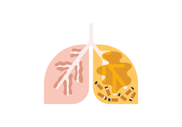 An illustration of a set of lungs, the left is pink and the right is yellow. The left has light pink veins running through it with lumpy darker pink buildup on the veins. The right lung has cigarette butts littering the bottom with a darker yellow smoke clouding the lung.