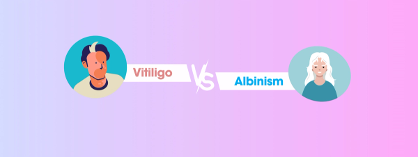 Vitiligo vs. Albinism