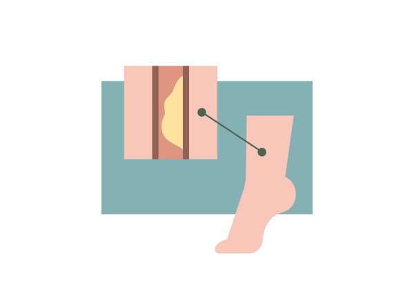 An illustration of a light peach-toned foot mid-step, with only the toes and ball of the foot on the ground. A dark green line connects a spot on the upper ankle to a cross section of an artery in the upper lefthand corner of the illustration. The borders of the artery are dark red and a large light yellow obstruction is on one side. The rest of the artery is light pink and the set of images is in front of a medium green rectangular background.