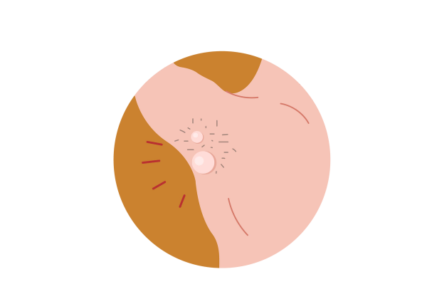 An illustration within a mustard yellow circle of a man's right armpit and shoulder with his arm raised. His skin is light peach-toned, and there are two lighter large lumps in his armpit, surrounded by grey medium length armpit hair. Four red lines come from the lumps.