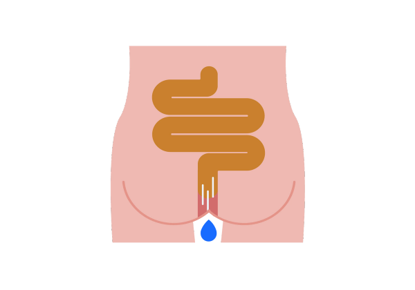 A person's backside showing a brown colon which turns red towards the anus, Three white action lines are inside the colon and a blue drop drips from the anus.