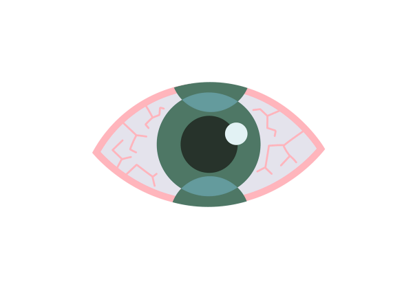 An illustration of an eye with a pink outline. Pink veins extend into the whites of the eye. The iris is medium green and the pupil is dark green. Two medium green circles overlap the iris, one on the top and one on the bottom.