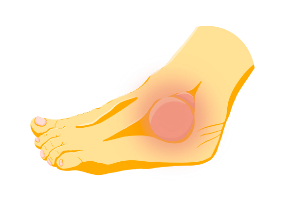 An illustration of a yellow foot with a large lump and a smaller lump above it on the ankle. The foot is lumpy. A red, gradient circle comes out of the lumps, showing pain and swelling.