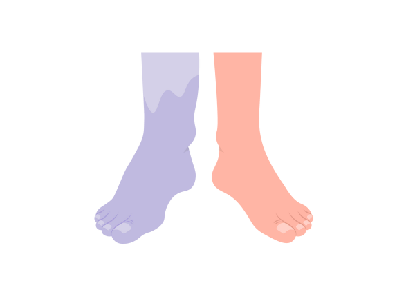 An illustration of two feet. The foot on the left is light purple and larger than the foot on the right, which is a light peach-tone and shows no swelling. The left foot has a lighter shade of purple on the shin above the ankle.