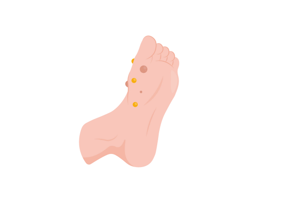 An illustration of the bottom of a light peach-toned foot with a cluster of small yellow and dark red rounded bumps near the big toe.