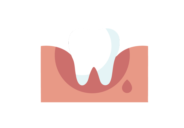 Gum with tooth, showing some bleeding.