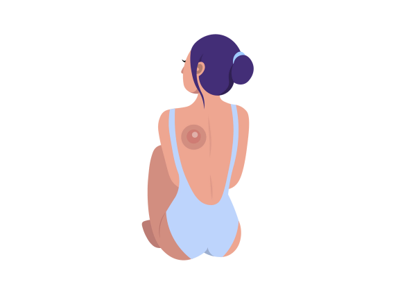 An illustration of a woman wearing a low back light blue bathing suit sitting facing away with her head turned slightly to the left. A large medium-red circle with another darker circle around it and a small lighter circle inside it is on her left shoulder blade. The rest of her skin is light-medium peach toned and her dark purple hair is tied in a loose bun with a light blue hair tie.