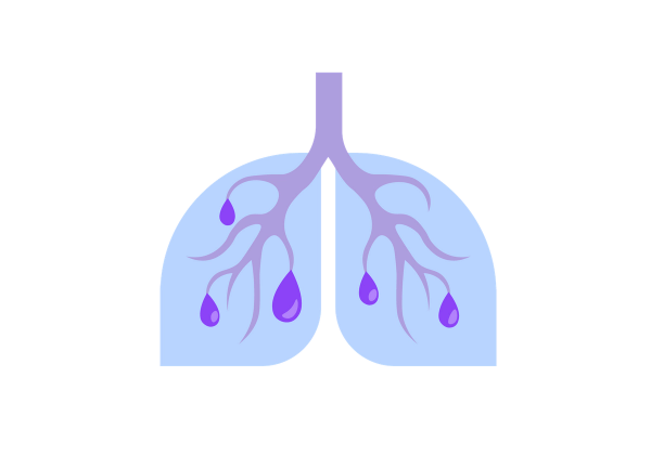 Lungs with walls filled with fluid and mucous.