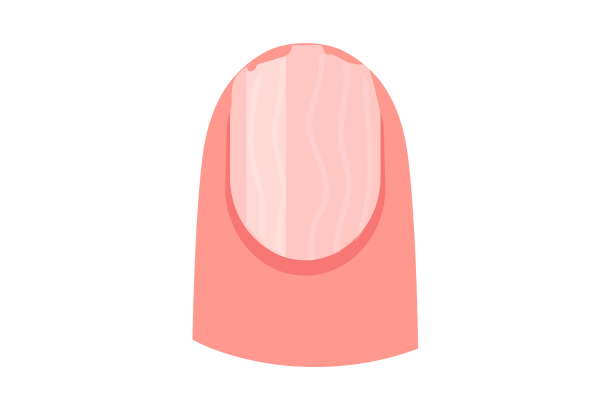 An illustration of a fingertip with a reddened nail bed and a light nail with wavy lines through it. The top of the nail is jagged and broken. The finger is a medium peach tone and the nail is a lighter peach tone.