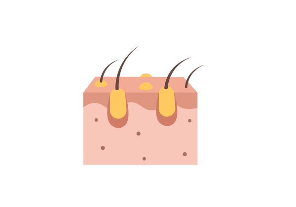 Cross section of the skin, showing infected hair follicles 