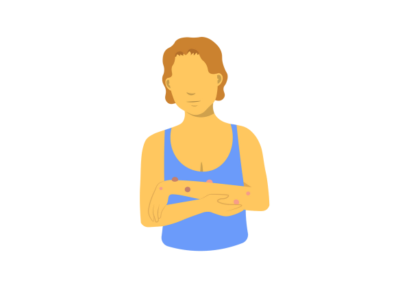 An illustration of a woman from the waist up looking down at her left arm, being held up in front of her by her right arm. There are varying shades of pink and red bumps on her left arm, and the rest of her skin is yellow. She has short, curly light brown hair and is wearing a light blue loose tank top.