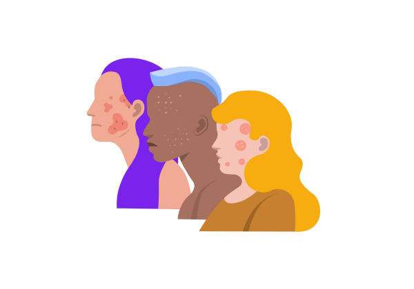 An illustration of three side profiles from the shoulders up, overlapping one another. The person furthest and leftmost has light-medium peach-toned skin with darker peach toned blotches on her cheeks and face. She is frowning and has long purple hair. The person in the middle has medium-dark warm brown skin and has lighter peach-toned spots on their face. They are frowning slightly and have a light blue short mohawk with the sides of their head shaved. The person closest and furthest right has light peach-toned skin with round darker peach splotches with lighter dots within the circles. She is frowning and has long blond curly hair and is wearing a mustard yellow shirt.