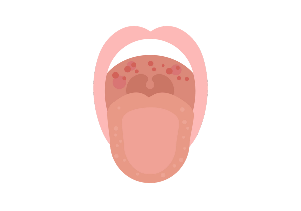 An open mouth with the tongue out, showing red spots in the mouth.