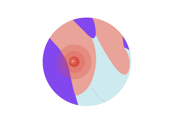 An illustration within a purple circle of a woman's armpit with her arm raised. She has light-medium peach toned skin and there is a bright red bump in her armpit with a smaller lighter circle inside and one more inside of that one. Two red translucent concentric circles come from the bump. She is wearing a light green tank top.