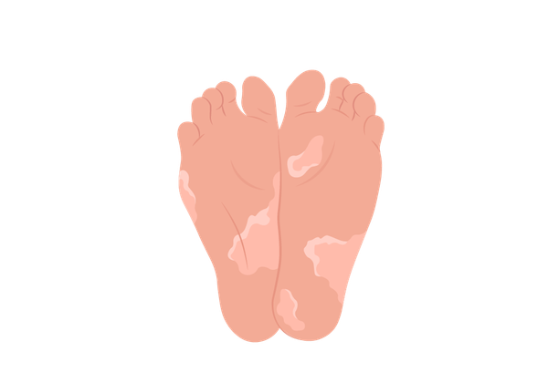 An illustration of two feet next to each other. The soles are covered in light peach-toned splotches, and the skin is slightly darker peach-toned. Each splotch has lighter splotches around the border.