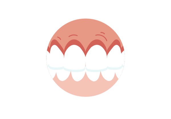 Clenched teeth with pain spots on the gums near the top row of teeth.