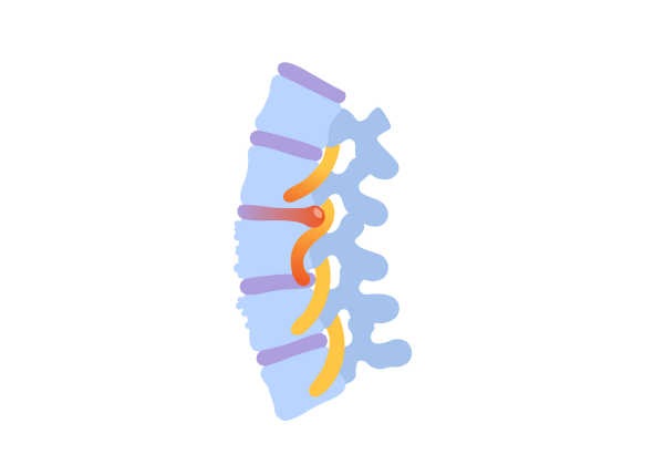 Eine Illustration des oberen Teils der Wirbelsäule. Es ist hellblau und zeigt Druck und Entzündung des Rückenmarks.