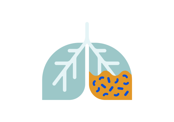 An illustration representing a set of light green lungs with lighter green veins running through them. The right lung has yellow fluid with blue lines and squiggles filling half the lung.