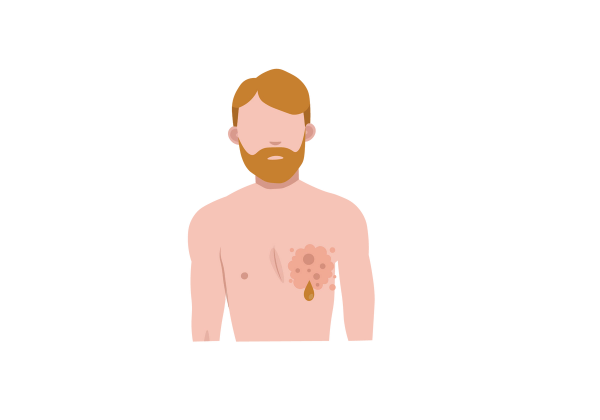 Man with a beard and a pink splotch on his left breast. A brown drop drips from the splotch.