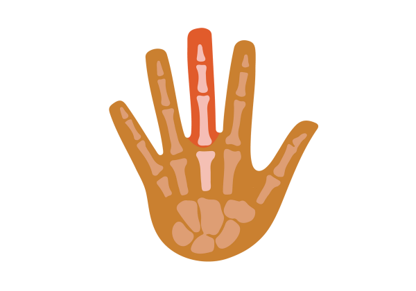 An illustration of a hand with outstretched fingers. The light brown bone is visible through the medium brown skin. The bones in and connecting to the middle finger are a lighter rosier shade and more emphasized. The middle finger is a bright orange-red.