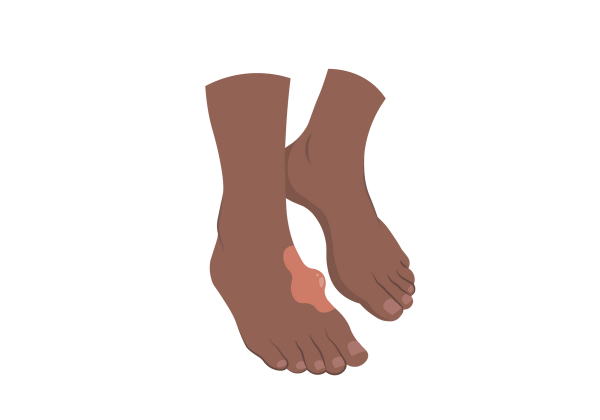 An illustration of two dark brown chocolate-toned feet, mid step. The foot towards the front has a lighter red splotch on the inside-top of the foot with a large lump protruding from the red-colored area.