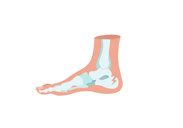 An illustration of a cross-section of a foot with the toes pointing left. The skin is light peach-toned, and light green bones are visible through the skin. The heel bone has a lightning bolt-shaped crack in it, and three short white lines come from the fracture.