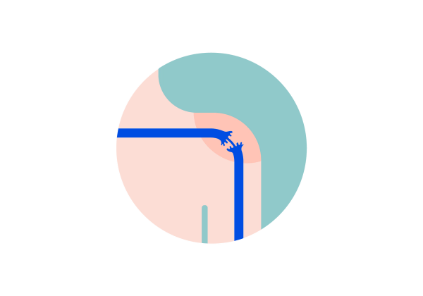 Shoulder with a blue frayed nerve within a green circle.