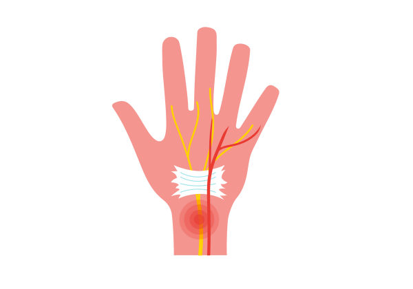 An illustration of a hand. Visible are the ligaments and nerves affected by carpal tunnel syndrome. Red concentric circles emanate from the wrist. Over the yellow nerve is a white patch.