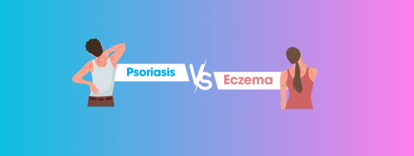 Psoriasis vs. Eczema