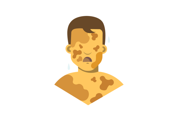 An illustration of a boy from the chest up facing forwards. His yellow skin is covered in darker yellow-brown blotches. Two blue drops are next to his head, one on each side. His mouth is open and frowning and he has short dark brown hair.