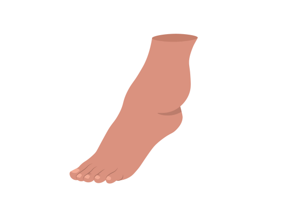 An illustration of a medium-dark peach-toned foot and ankle. The ankle has a large bulge on the outer side. The toenails are a slightly lighter shade than the skin tone.