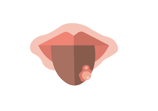 An illustration of a brown tongue sticking out of pink lips. An area of two pink sores are on the lower right of the tongue.