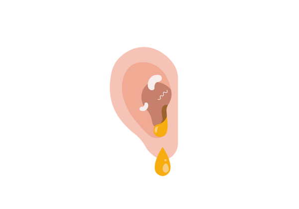 An ear with a visible infection. A droplet of pus can be seen leaking out of the ear.