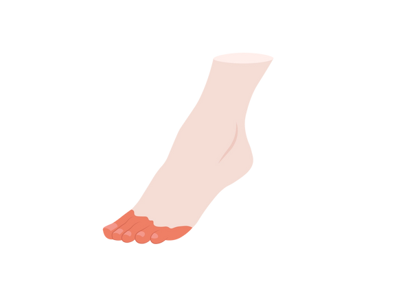 Red Toes Color Red Toes | What Causes Toe Redness & How to Treat