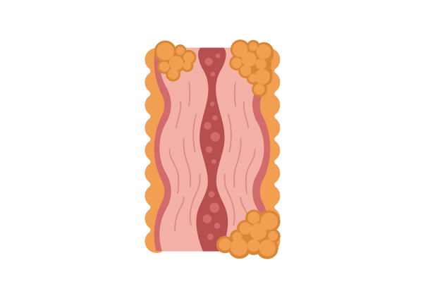 A pink colon with thick walls and a red inside with pink spots. Dark yellow bubbles surround the section.