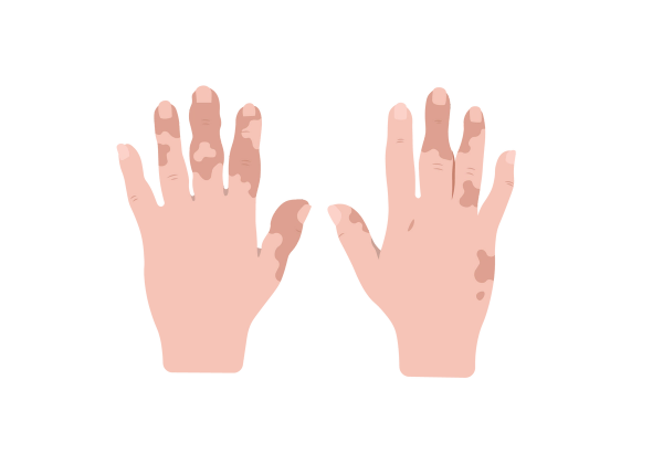 An illustration of the top of a pair of hands with outstretched fingers. There are reddish-peach blotches on the light peach-toned skin.