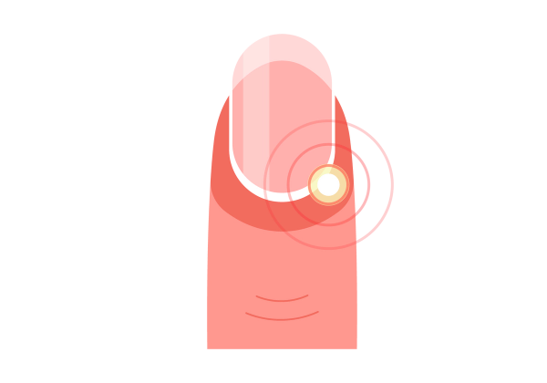 An illustration of a fingertip with redness around the nail base. The white cuticle is shown. A yellow spot is on the edge of the cuticle towards the bottom right of the nail bed. Two red concentric circles come out from the yellow spot, emphasizing the infection. The rest of the finger is light-medium rosy-peach toned.