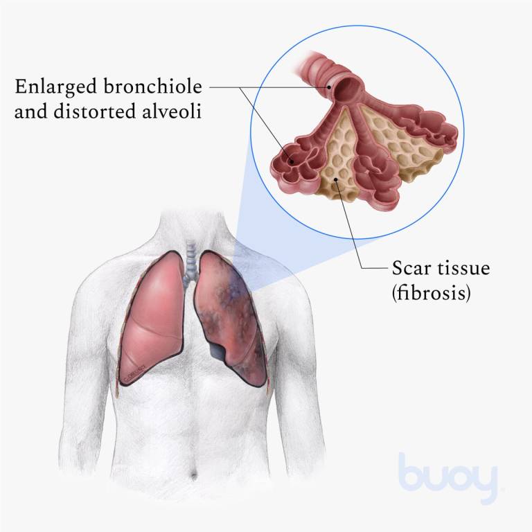 Fibrose pulmonaire | Quels sont les symptmes et le traitement ?