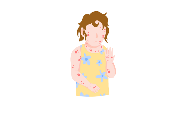 An illustration of a frowning little girl scratching herself with one hand and looking at the other hand. She is covered in clusters of red spots. She has short brown messy hair and is wearing a yellow dress with light blue flowers. Her skin is light peach and the chickenpox is bright red.