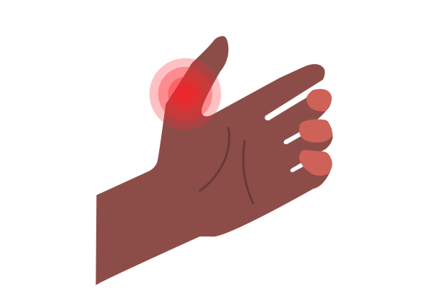 An illustration of the inside of a hand with the fingers relaxed and bent slightly and the thumb sticking up. Red concentric circles showing pain come from the base of the thumb. The rest of the hand is dark mocha toned.