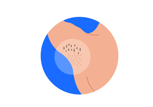 An illustration inside a medium blue circle of an armpit and shoulder with the arm raised. A semi-transparent white circle covers the whole armpit. At the top of the armpit, there is a cluster of brown hairs, and below that are pink dots where there is no hair. The rest of their skin is light peach-toned.