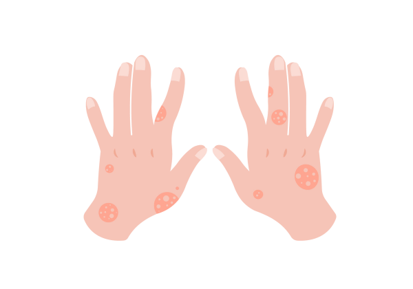 An illustration of a set of light peach-toned hands, showing the backs of them. The fingers are mostly stretched straight and there are darker peach-toned circles spotting the hands. Inside the circles are smaller circles that match the rest of the skin tone.